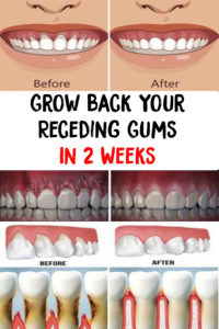 Grow-Back-Your-Receding-Gums-In-2-Weeks