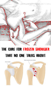 The Cure For Frozen Shoulder
